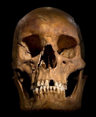 Figure 9: The skull of Richard III, showing some of the evidence of the weapon trauma inflicted during the battle (Buckley et al. 201a, 14-15).